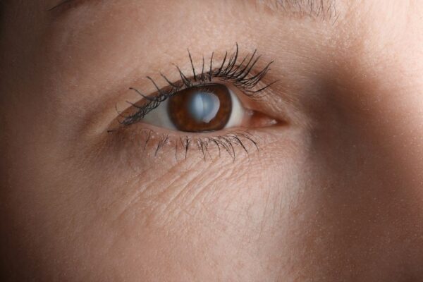 Can You Get LASIK if You Have a Cataract? featured image